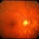 Birdshot Retinochoroidopathy